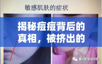 揭秘痘痘背后的真相，被擠出的白色物質(zhì)究竟是什么？