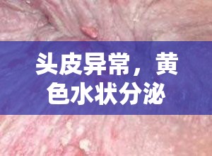 頭皮異常，黃色水狀分泌物與惡臭的警鐘