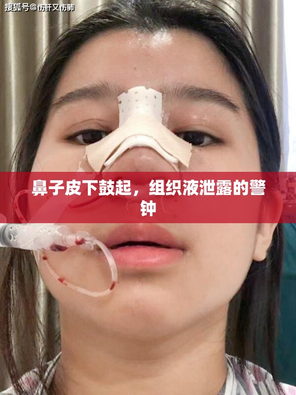 鼻子皮下鼓起，組織液泄露的警鐘