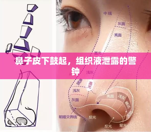 鼻子皮下鼓起，組織液泄露的警鐘