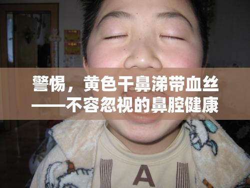 警惕，黃色干鼻涕帶血絲——不容忽視的鼻腔健康警報(bào)