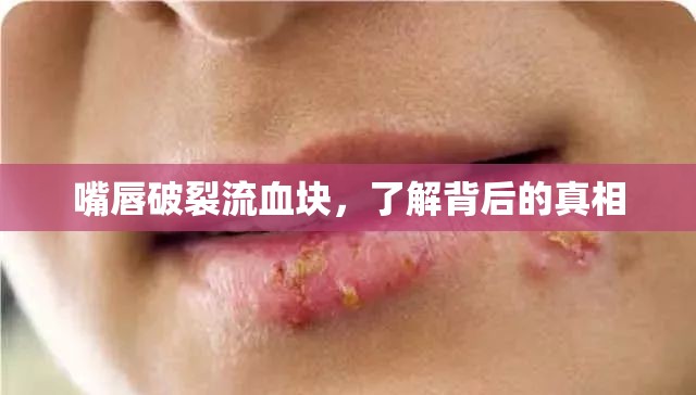 嘴唇破裂流血塊，了解背后的真相
