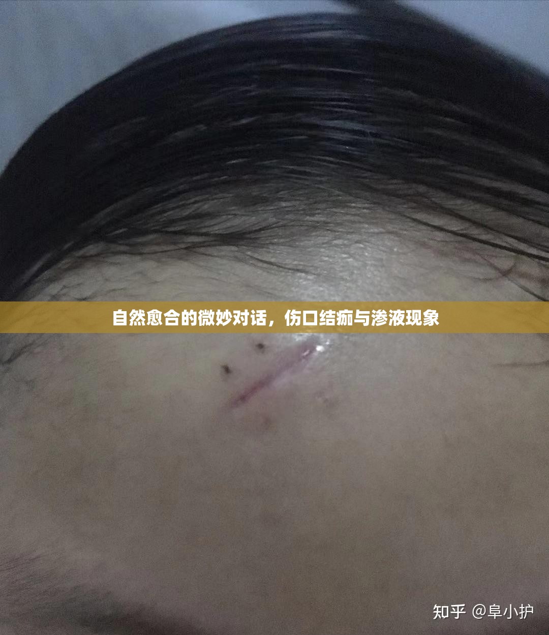 自然愈合的微妙對話，傷口結(jié)痂與滲液現(xiàn)象