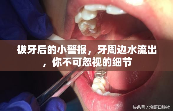拔牙后的小警報，牙周邊水流出，你不可忽視的細(xì)節(jié)