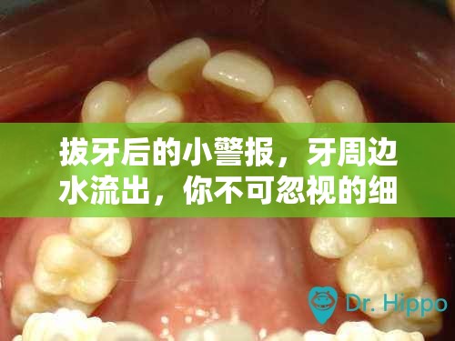 拔牙后的小警報，牙周邊水流出，你不可忽視的細(xì)節(jié)