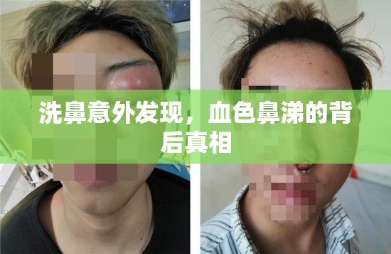 洗鼻意外發(fā)現(xiàn)，血色鼻涕的背后真相