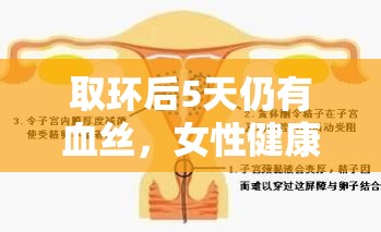 取環(huán)后5天仍有血絲，女性健康小貼士
