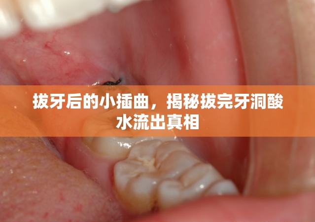 拔牙后的小插曲，揭秘拔完牙洞酸水流出真相