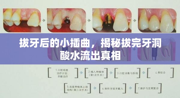 拔牙后的小插曲，揭秘拔完牙洞酸水流出真相
