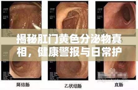揭秘肛門黃色分泌物真相，健康警報與日常護理指南