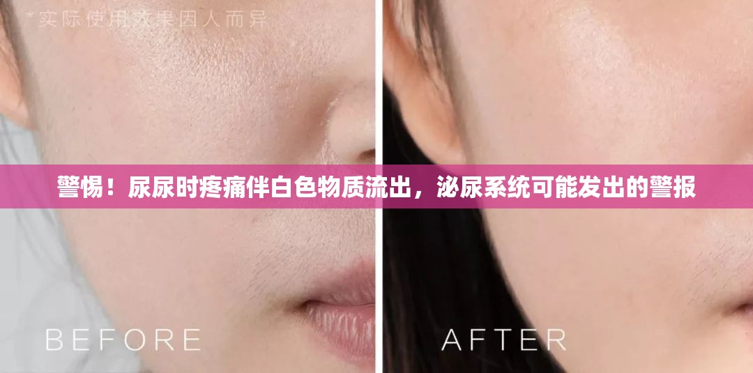 警惕！尿尿時(shí)疼痛伴白色物質(zhì)流出，泌尿系統(tǒng)可能發(fā)出的警報(bào)