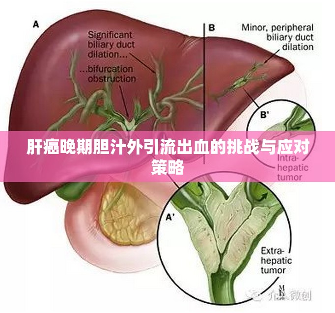 肝癌晚期膽汁外引流出血的挑戰(zhàn)與應(yīng)對(duì)策略