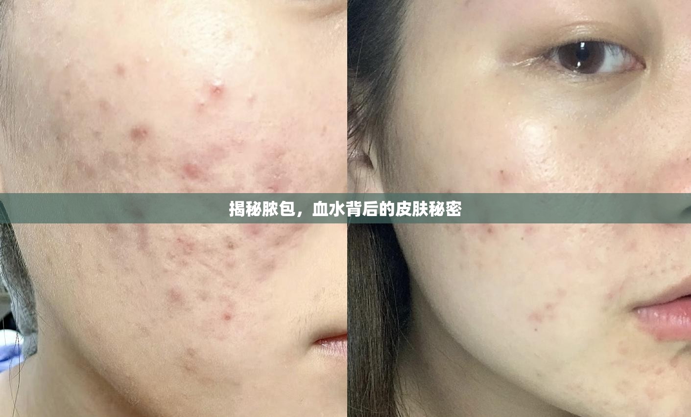 揭秘膿包，血水背后的皮膚秘密