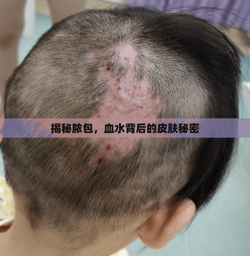 揭秘膿包，血水背后的皮膚秘密