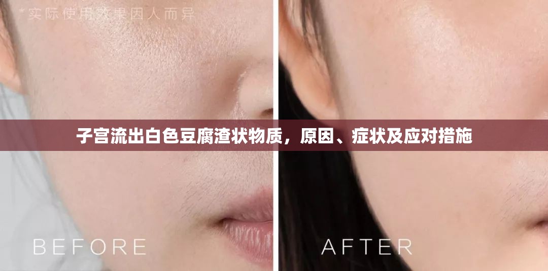 子宮流出白色豆腐渣狀物質(zhì)，原因、癥狀及應(yīng)對(duì)措施
