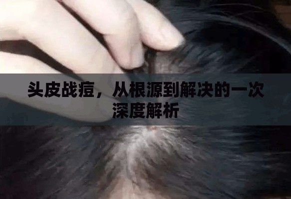 頭皮戰(zhàn)痘，從根源到解決的一次深度解析
