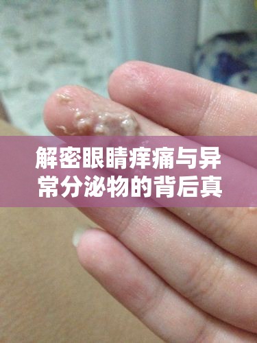 解密眼睛癢痛與異常分泌物的背后真相