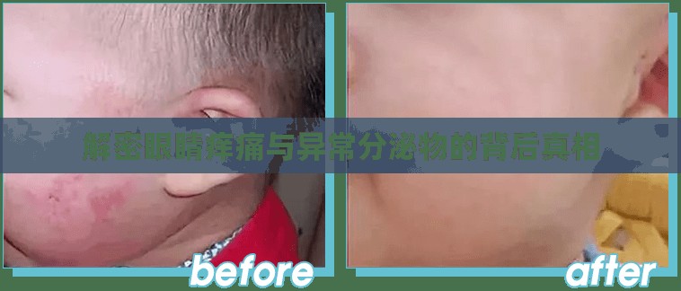 解密眼睛癢痛與異常分泌物的背后真相