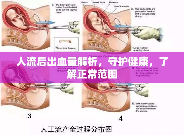人流后出血量解析，守護健康，了解正常范圍