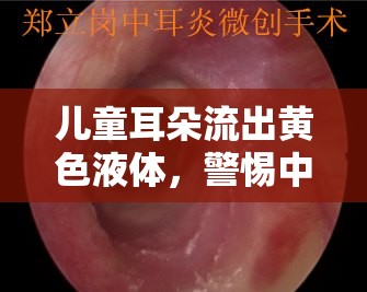 兒童耳朵流出黃色液體，警惕中耳炎的跡象