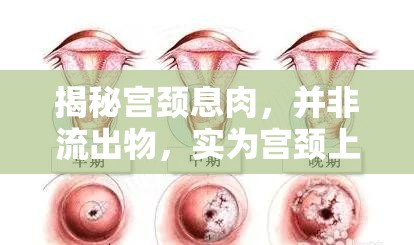 揭秘宮頸息肉，并非流出物，實為宮頸上的小肉芽