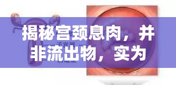 揭秘宮頸息肉，并非流出物，實為宮頸上的小肉芽