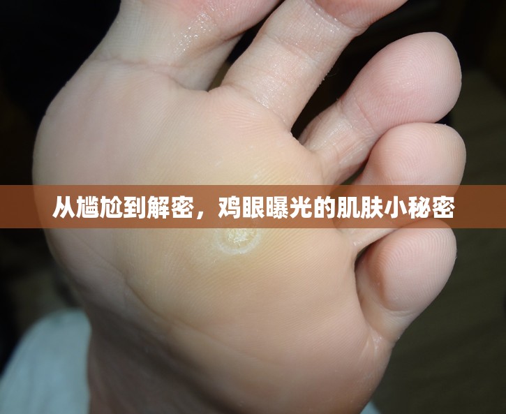 從尷尬到解密，雞眼曝光的肌膚小秘密