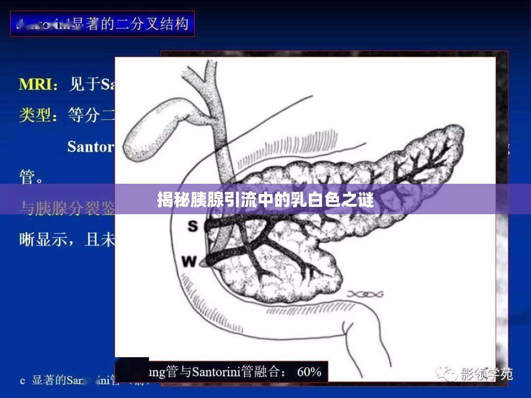 揭秘胰腺引流中的乳白色之謎