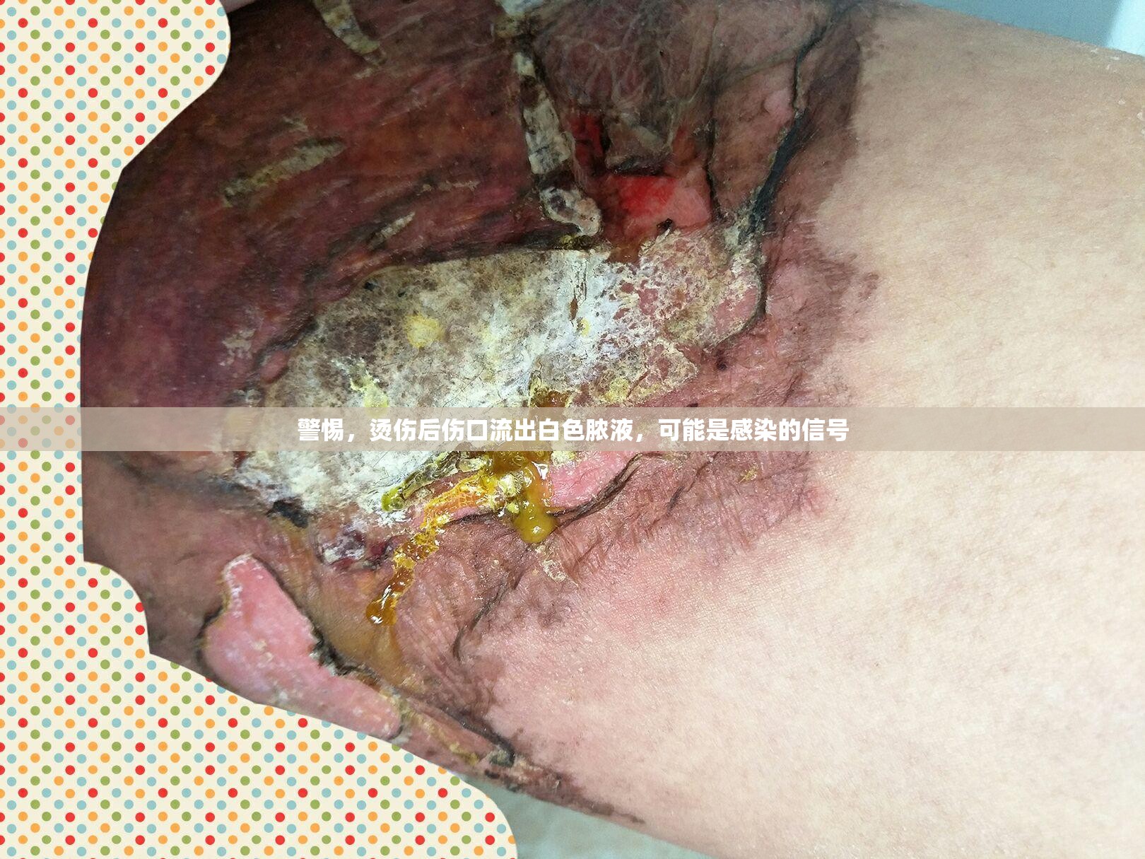 警惕，燙傷后傷口流出白色膿液，可能是感染的信號(hào)