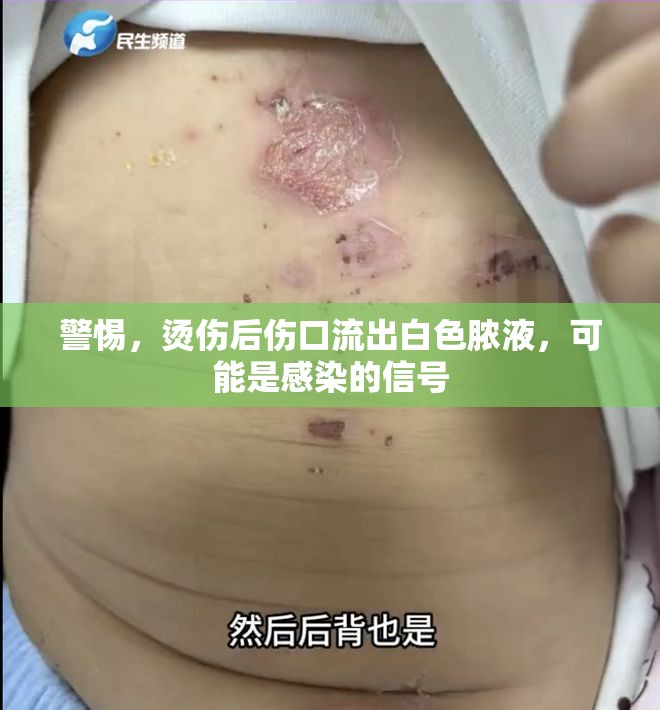 警惕，燙傷后傷口流出白色膿液，可能是感染的信號(hào)