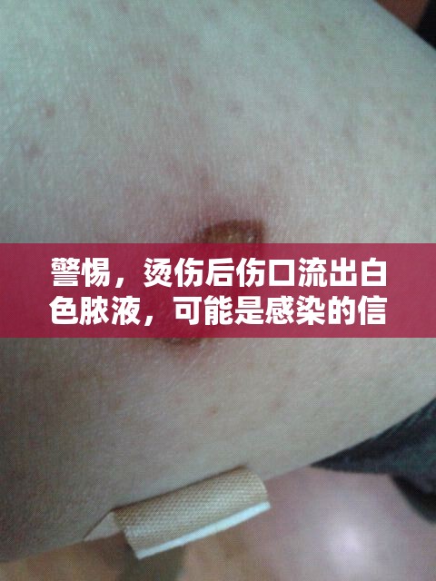 警惕，燙傷后傷口流出白色膿液，可能是感染的信號(hào)