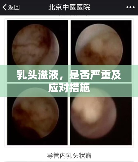 乳頭溢液，是否嚴(yán)重及應(yīng)對(duì)措施