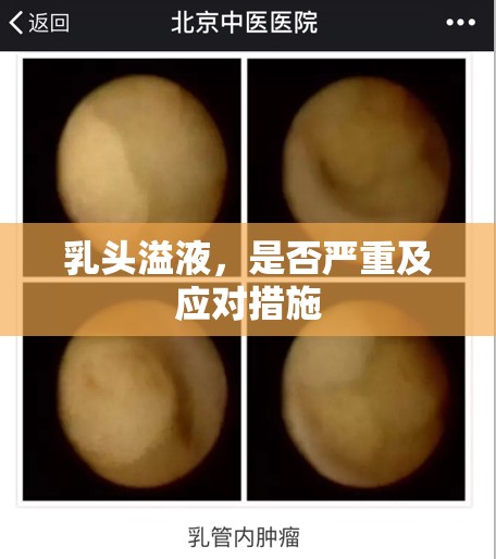 乳頭溢液，是否嚴(yán)重及應(yīng)對(duì)措施