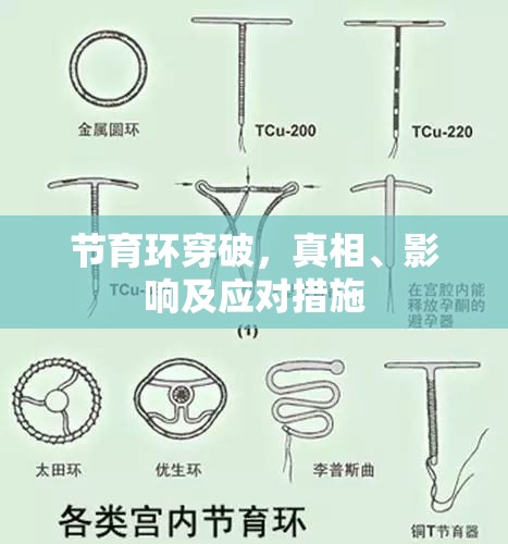 節(jié)育環(huán)穿破，真相、影響及應(yīng)對措施