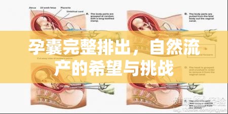 孕囊完整排出，自然流產(chǎn)的希望與挑戰(zhàn)