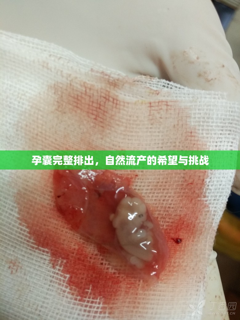 孕囊完整排出，自然流產(chǎn)的希望與挑戰(zhàn)