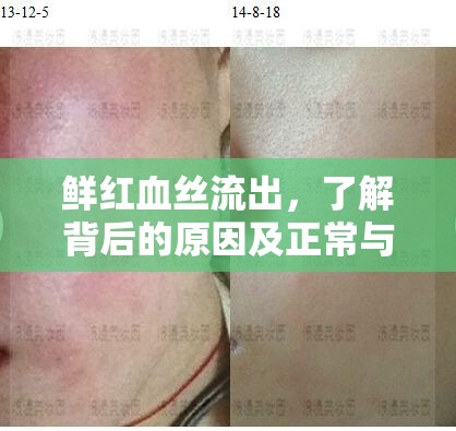鮮紅血絲流出，了解背后的原因及正常與否的判斷