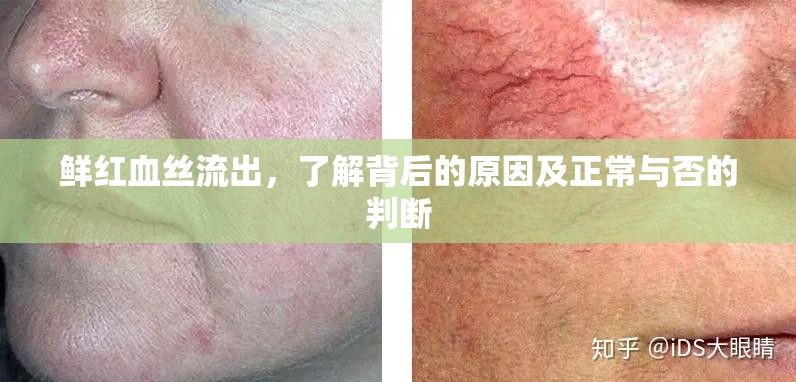 鮮紅血絲流出，了解背后的原因及正常與否的判斷