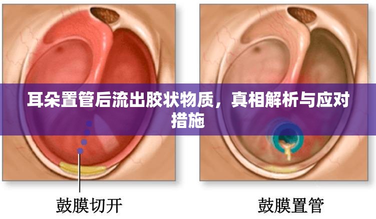 耳朵置管后流出膠狀物質(zhì)，真相解析與應(yīng)對(duì)措施
