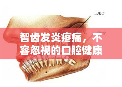 智齒發(fā)炎疼痛，不容忽視的口腔健康警報
