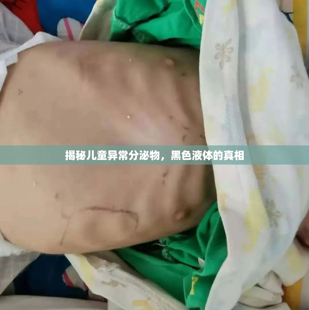 揭秘兒童異常分泌物，黑色液體的真相