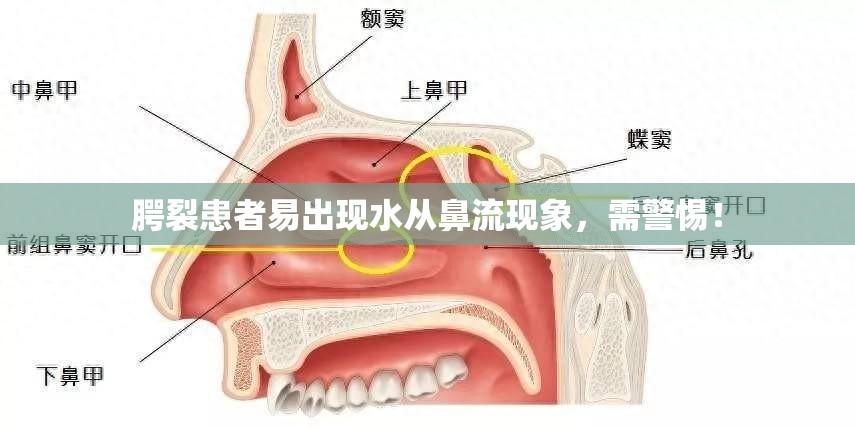 腭裂患者易出現(xiàn)水從鼻流現(xiàn)象，需警惕！