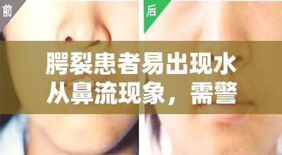 腭裂患者易出現(xiàn)水從鼻流現(xiàn)象，需警惕！