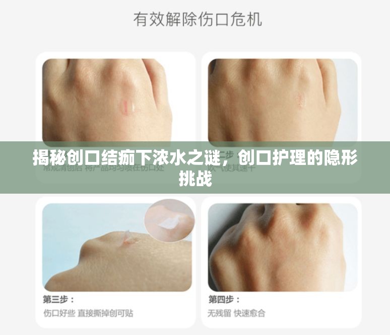 揭秘創(chuàng)口結(jié)痂下濃水之謎，創(chuàng)口護(hù)理的隱形挑戰(zhàn)