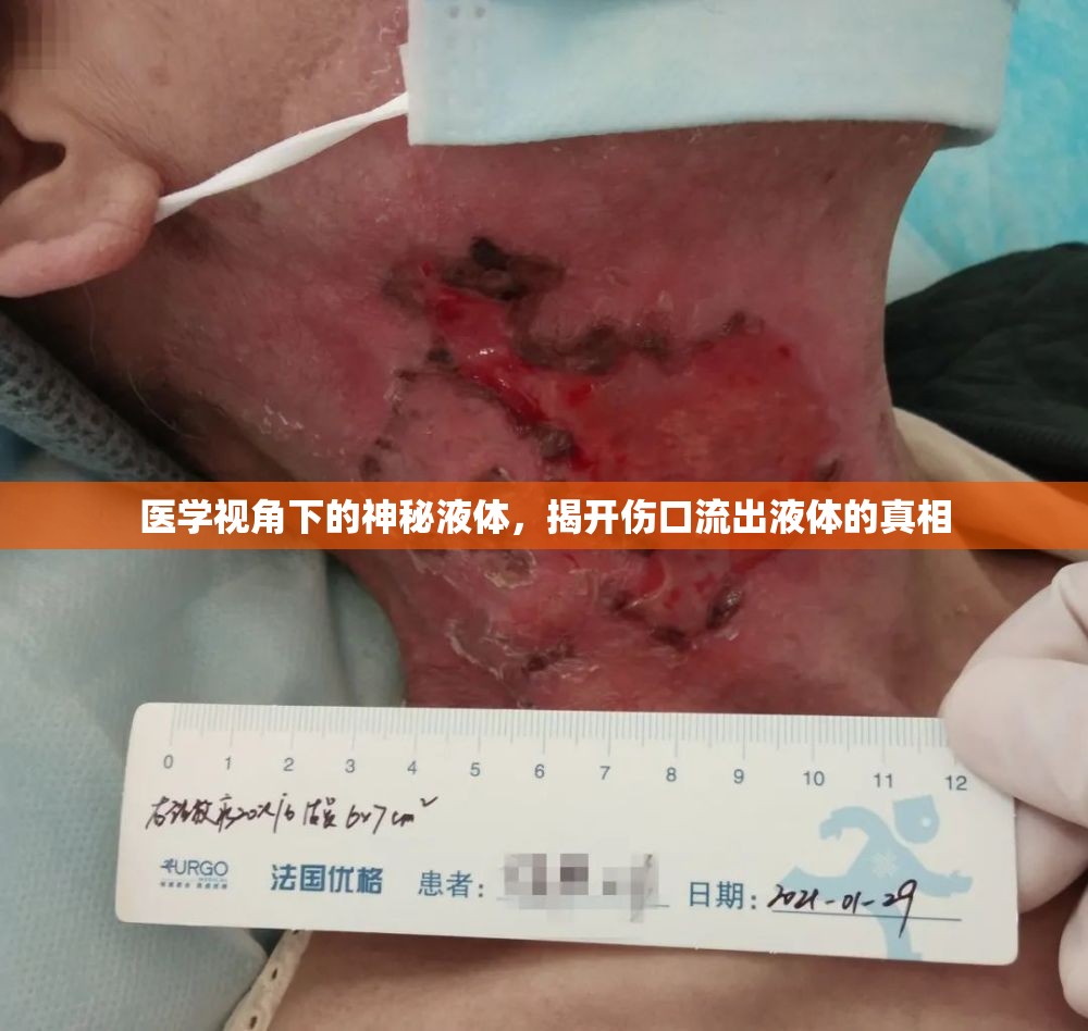 醫(yī)學(xué)視角下的神秘液體，揭開傷口流出液體的真相