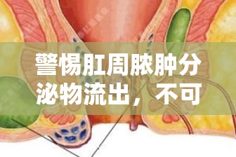 警惕肛周膿腫分泌物流出，不可忽視的健康警報