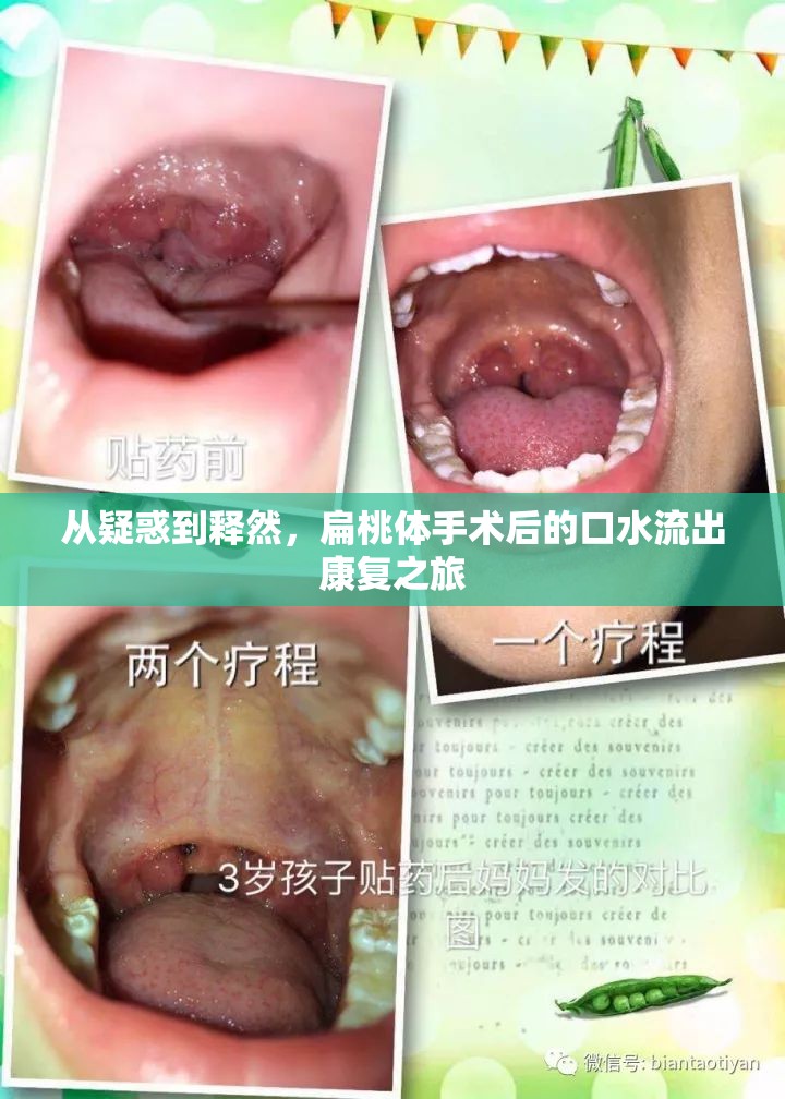 從疑惑到釋然，扁桃體手術(shù)后的口水流出康復(fù)之旅