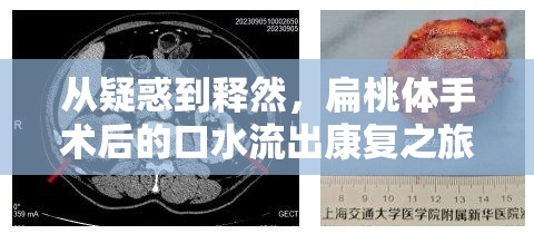從疑惑到釋然，扁桃體手術(shù)后的口水流出康復(fù)之旅