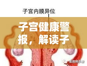 子宮健康警報(bào)，解讀子宮內(nèi)異味液體的成因與影響