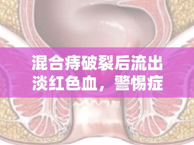 混合痔破裂后流出淡紅色血，警惕癥狀與預防措施